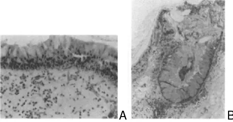 Gambar 1. A. Edematous, Eosinophilic Polyp(tanda panah) dan stroma longgar yang mengandung pseudocystic berisi cairan.banyak adalah eosinofil dan sel mast