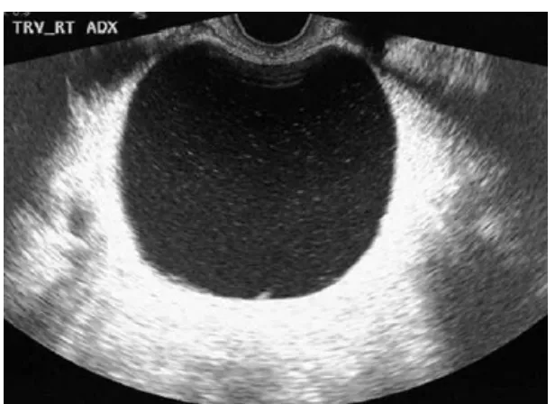 Gambar 2. Gambaran ultrasonografi transvaginal Kista 