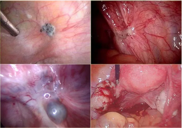 Gambar 4. Lesi endometriosis pada peritoneum pelvis1