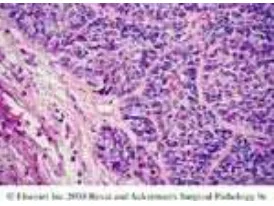 Gambar 5. Karsinoma sel skuamous tipe basaloid. Pertumbuhan tumor dalam bentuk sarang – sarang yang berbatas tegas dengan  peripheral palisading.( Dikutip dari: Rosai J