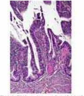 Gambar 9. Mikroskopis adenokarsinoma tipe villoglandular. Arsitektur seperti villous 