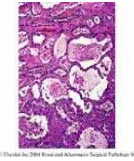 Gambar 10. Adenokarsinoma serviks tipe clear cell menunjukkan gambaran tubular, mikrokistik dan tubulokistik