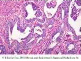 Gambar 11. Mesonephric gland carcinoma pada serviks. (Dikutip dari Rosai J. Rosai and Ackerman’s : Surgical Pathology
