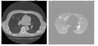 Gambar 3. Hasil segmentasi citra CT[11]