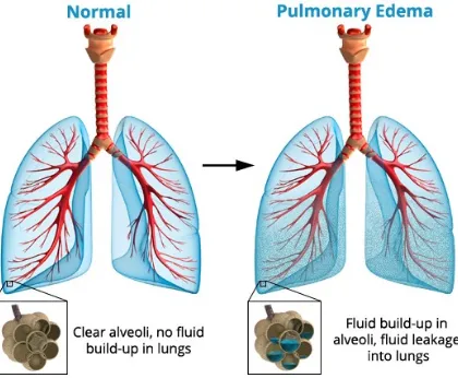 Gambar 1. Ilustrasi Edema Paru