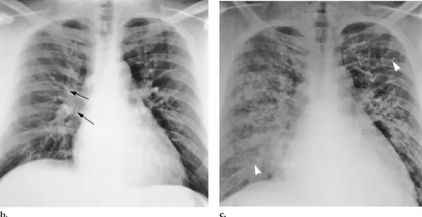 Gambar 10. Gambaran foto thorax pada pasien laki-laki, 33 tahun dengan edema