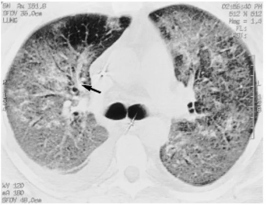Gambar 11.  Gambaran CT-scan pada pasien laki-laki 53 tahun, dengan edema
