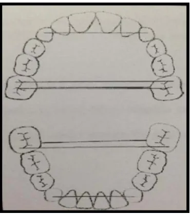 Gambar 2. Pengukuran lengkung  gigi secara transversal  dengan metode Lindsten16  