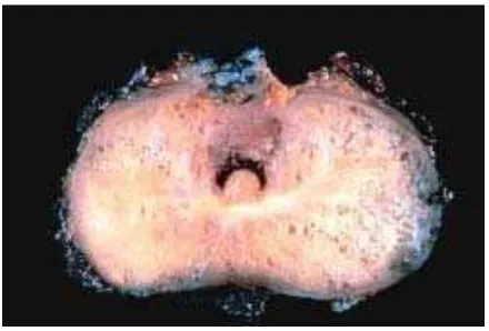 Gambar 2.3. Makroskopis adenokarsinoma prostat (Dikutip dari: Kumar V, Abbas AK, Fausto N
