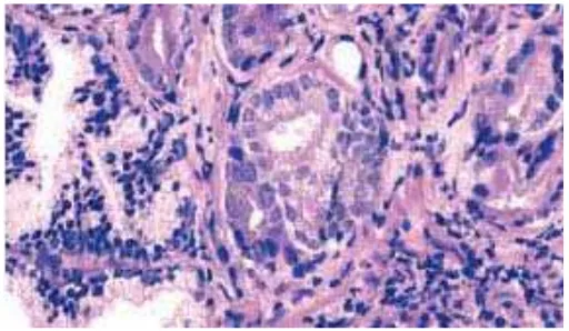 Gambar 2.4. Adenokarsinoma prostat dengan sitoplasma yang amphophilic dan inti membesar serta nukleoli yang menonjol (Dikutip dari: Eble JN, Sauter G, Epstein JI, Sesterhenn IA