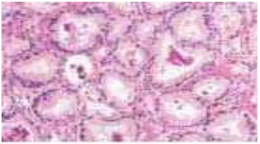 Gambar 2.5. Kristaloid intraluminal pada adenokarsinoma prostat yang low gradeEble JN, Sauter G, Epstein JI, Sesterhenn IA