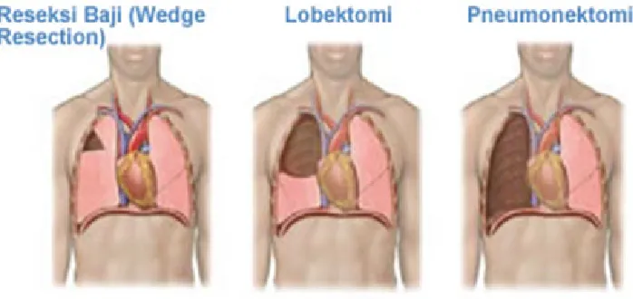 Gambar 2.5 Jenis Pembedahan (google.com)