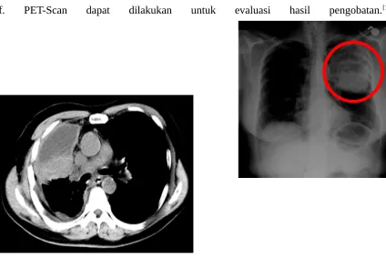 Gambar 2.4 Gambaran CT-Thorax dan Rontgen Thorax (google.com)