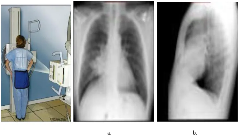 Gambar   a) Rontgen thorax AP dan b)  Lateral