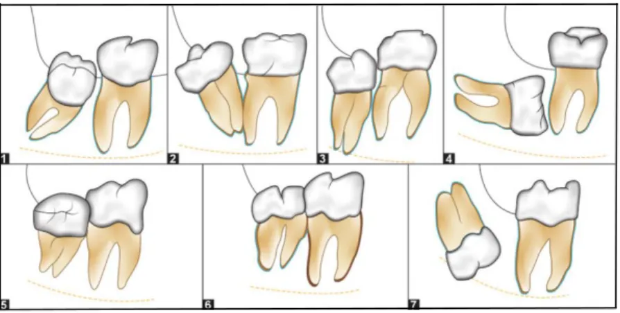 Gambar 3. Klasifikasi impaksi molar ketiga mandibula menurut        GeorgeWinter. 27 