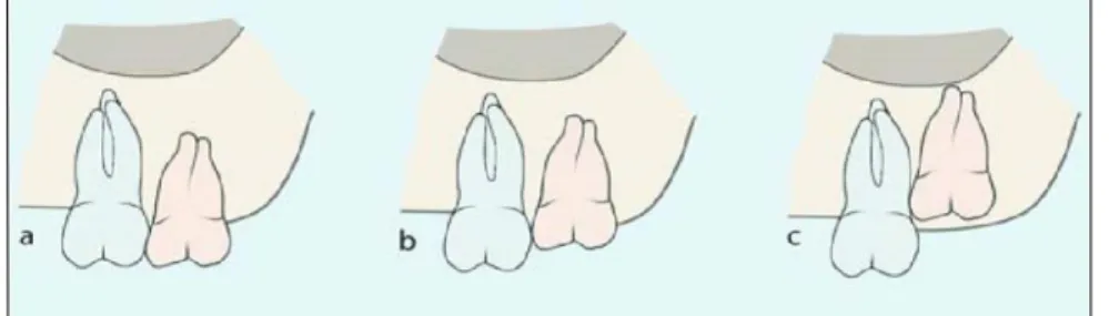 Gambar 5. Klasifikasi impaksi molar ketiga maksila menurut kelas       A,B,C menurut Archer