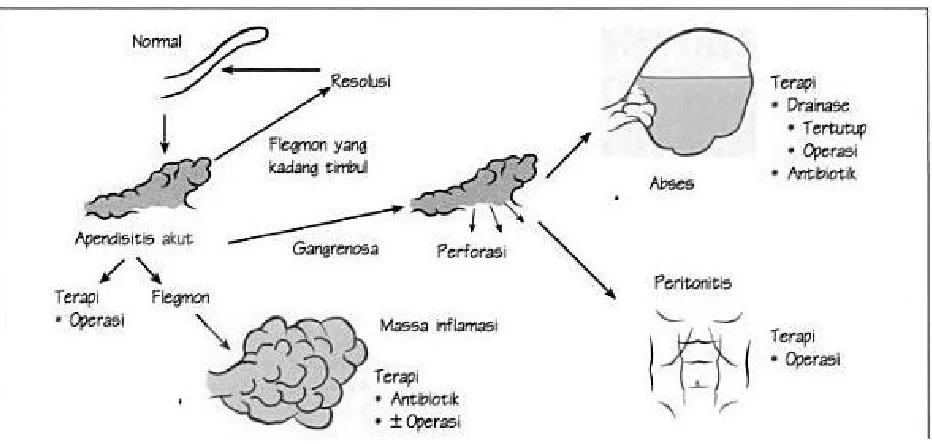 Gambar 3. Pathogenesis Appendisitis