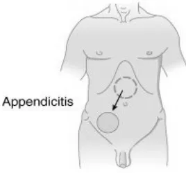 Gambar 4. Lokasi Nyeri pada Appendisitis