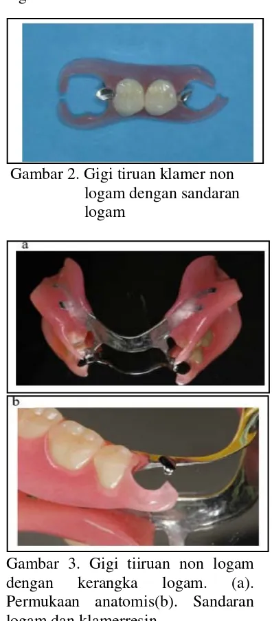 Gambar 1. Gigi tiruan klamer non logam 