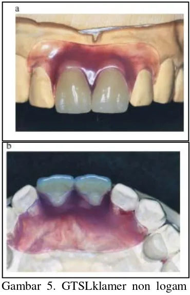 Gambar 5. GTSLklamer non logam tanpa kerangka logam pada bagian frontal maksila bilateral gigi depan