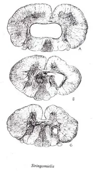 Gambar 2. Syringomyelia 