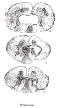 Gambar 2. Syringomyelia 