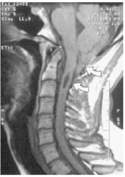 Gambar 3. MRI Syringomyelia yang menyertai Malformasi Chiari I 