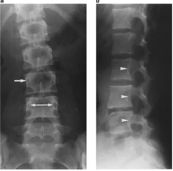 Gambar 4. Foto x-ray Lumbal. Foto X-ray Lumbal pada pasien dengan syrinx yang besar dan Dikutip dari : malformasi Chiari tipe 1
