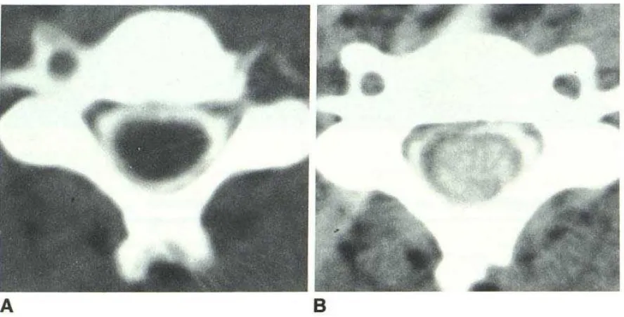Gambar 5. Communicating Syringomyelia pada Myelografi.Myelogram metrizamide Dikutip dari : konvensional menunjukkan pembesaran dari medula dari C3 sampai ke T3
