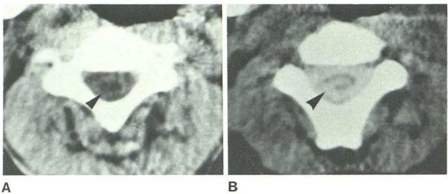 Gambar 8 Gambaran pada CT-Myelographypemberian metrizamide. Hiperdensitas sentral pada medula bersamaan dengan adanya kanal 