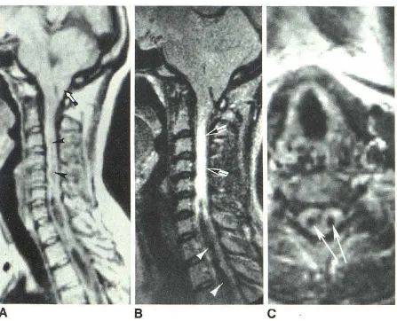 Gambar 11. Wanita usia 44 tahun dengan Malformasi Chiari tipe I dan syringomyeliaDikutip dari :Gambar panah putih menunjukkan tonsil serebelar 12 mm di bawah foramen magnum