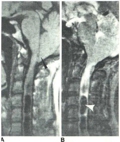 Gambar 12. Wanita 46 tahun dengan Malformasi Chiari tipe I dan syringomyelia. Bentuk Dikutip dari :“beaded” pada kavitas syrinx