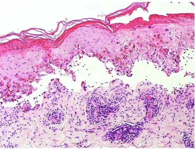 Gambar 2 Histopatologi SJS/TEN. Terdapat keratinosit apoptotik multipel pada seluruh 