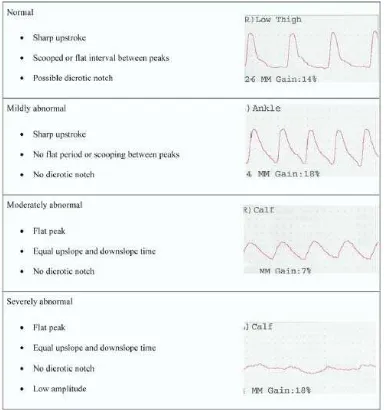 Gambar 6. Pulsasi volume dengan derajat keparahan penyakit pembuluh darah.plethysmography: Bentuk pulse volume recording 16 