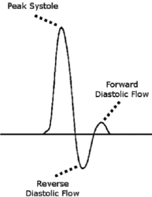 Gambar 7. Ilustrasi gelombang trifasik Doppler.2