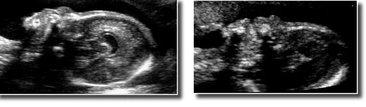 gambar embrio yang tak jelas. Tanda –tanda diatas sering berkaitan dengan terjadinya abortus spontan 