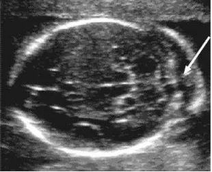 Fig.1. Axial image of the fetal head shows thickening of nuchal fold. Nuchal fold is measured during the second trimester on an axial image slightly off the biparietal diameter plane