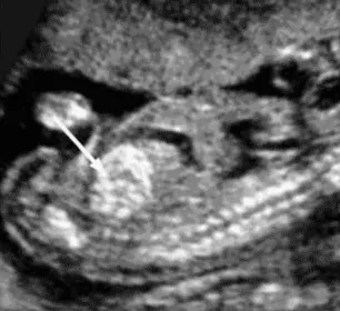 Fig.2. Sagittal image of fetal abdomen shows echogenic bowel. The image should include fetal bowel, liver and iliac bone for comparison
