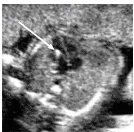 Fig.3. Four-chamber view of the heart showing a single echogenic intracardiac focus on left side 