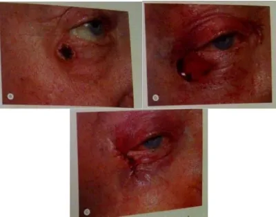 Gambar 3 Pasien dengan KSB di kelopak mata bawa kiri 