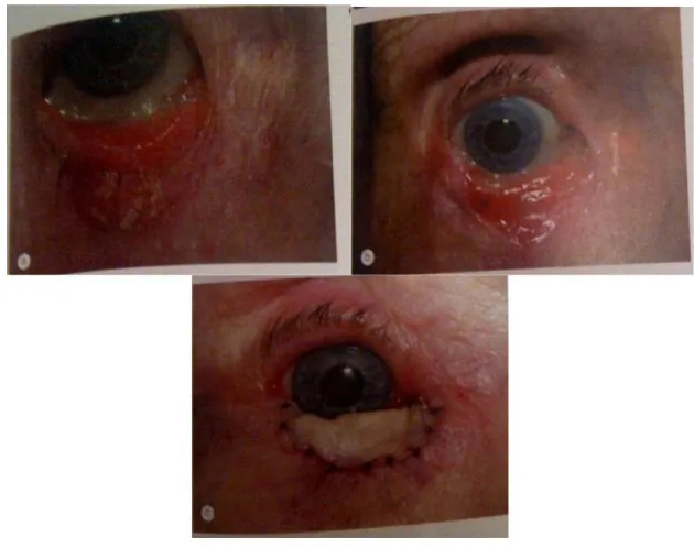 Gambar 7 Anterior lamellar reconstruction with a free skin graft.(a)preoperative appearance; (b) appearance following excision; (c) skin graft in place 