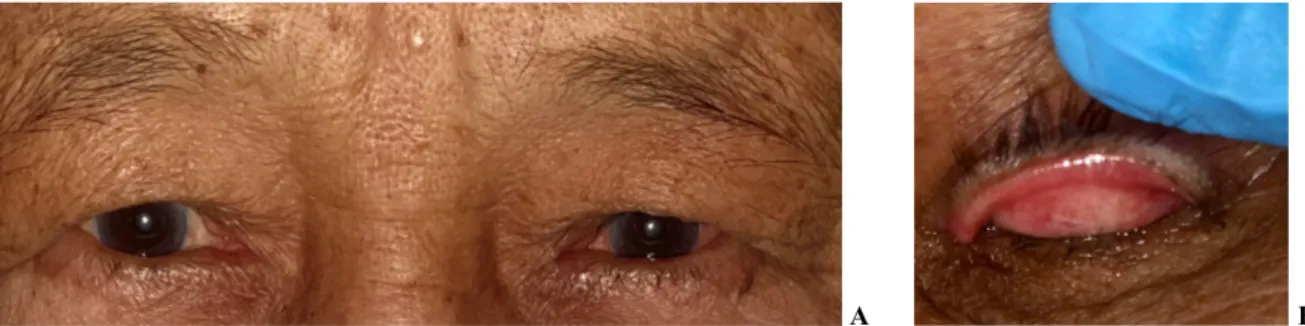 Gambar 2.1   Foto klinis mata pasien pre-operasi. a) kedua mata   pasien. b) eversi   kelopak mata atas menunjukkan distikiasis pada regio lateral  Dikutip dari: PMN RS Mata Cicendo Bandung