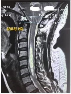 Figure 1. Sagittal T1-weighted MR image of the brain showing herniation of cerebellar tonsils and a low-lying obex characteristic of Chiari malformation Type I