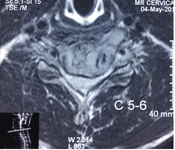 Figure 1.  MRI spine T2 sagital showed compression fractures from C5 to C6  and significant spinal cord compression