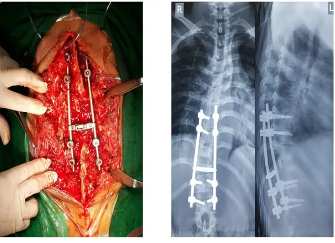 Figure 6. Drainage abcess was performed 
