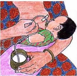 Gambar 1. Menyusu dengan cangkir dan slang plastica (Sumber: Breastfeeding Counseling: A training course