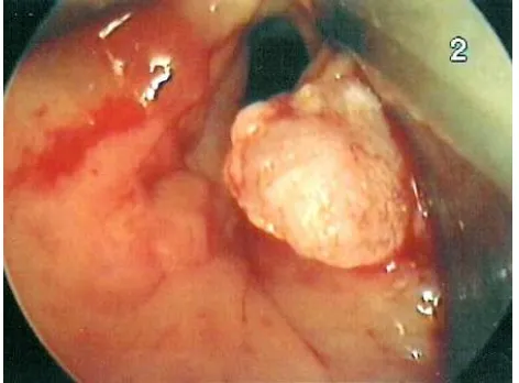 Gambar 4.1, Tumor laring supraglotis 