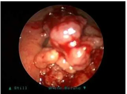 Gambar 4.2, tumor laring glotis 