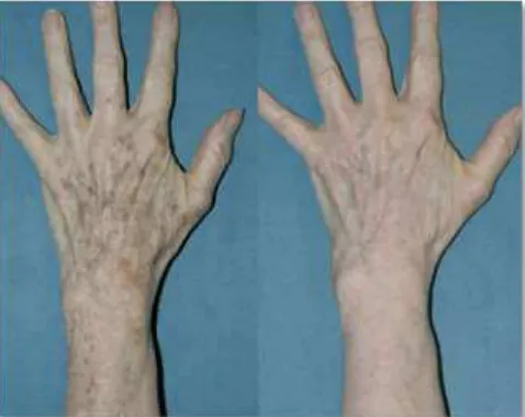 Gambar 4.  Sebelum (kiri) dan 26 minggu setelah (kanan) terapi laser Q-switched alexandrite kombinasi dengan terapi laser CO2 fractionated pada tangan.3 