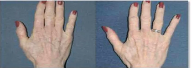 Gambar 5. Sebelum (kiri) dan 6 minggu setelah (kanan) terapi fotodinamik tangan.3